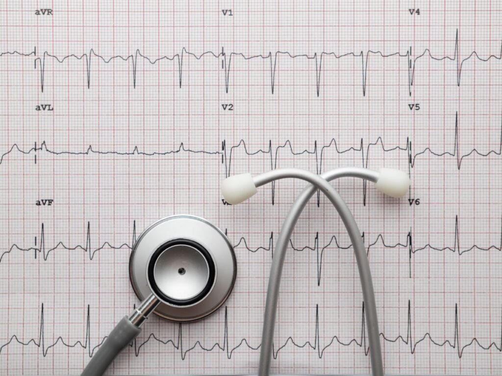ecg diagram
